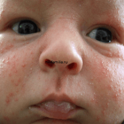 What Causes Baby Acne