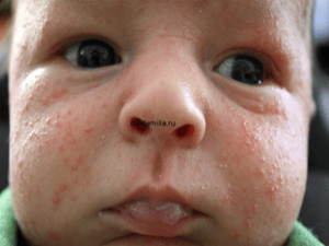 What Causes Baby Acne