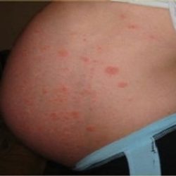 Dealing with Skin Breakouts during Pregnancy