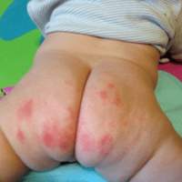 Diaper Rashes – Causes, Treatment, Home Remedies and Precautions