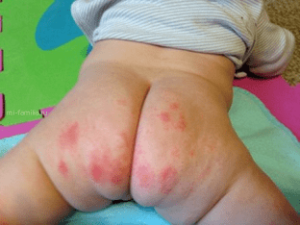 Diaper Rashes – Causes, Treatment, Home Remedies and Precautions