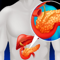 Что такое панкреатит? Симптомы и последствия
