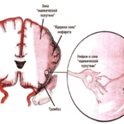 Ишемия головного мозга