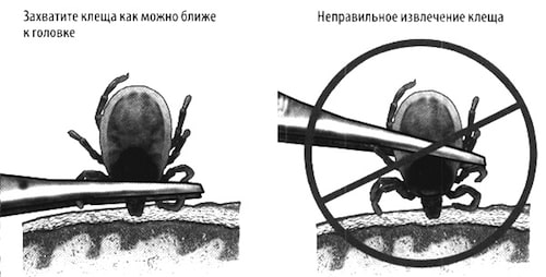 Как обработать рану после укуса клеща